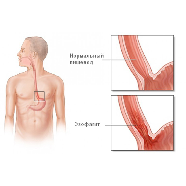 ЭЗОФАГИТ