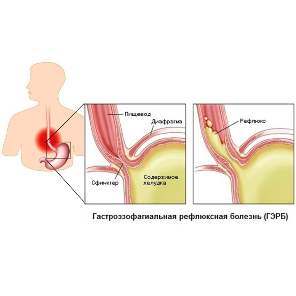 ГАСТРОЭЗОФАГЕАЛЬНАЯ РЕФЛЮКСНАЯ БОЛЕЗНЬ