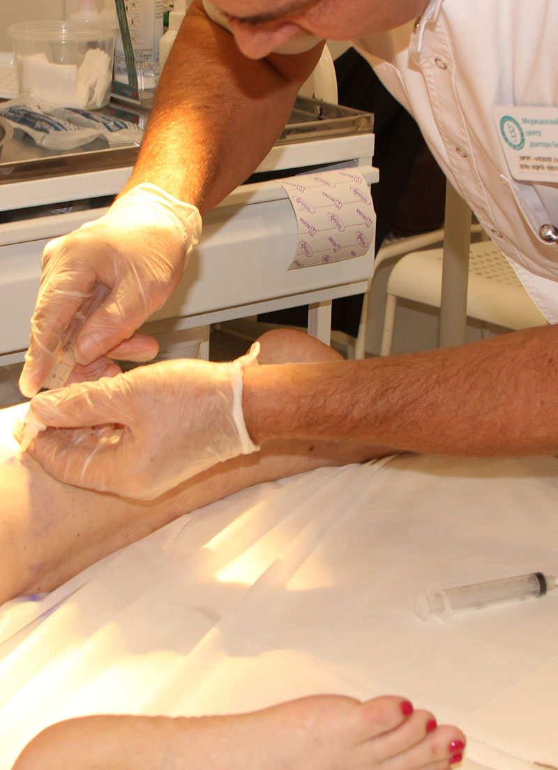 Удаление сосудистых звездочек на ногах