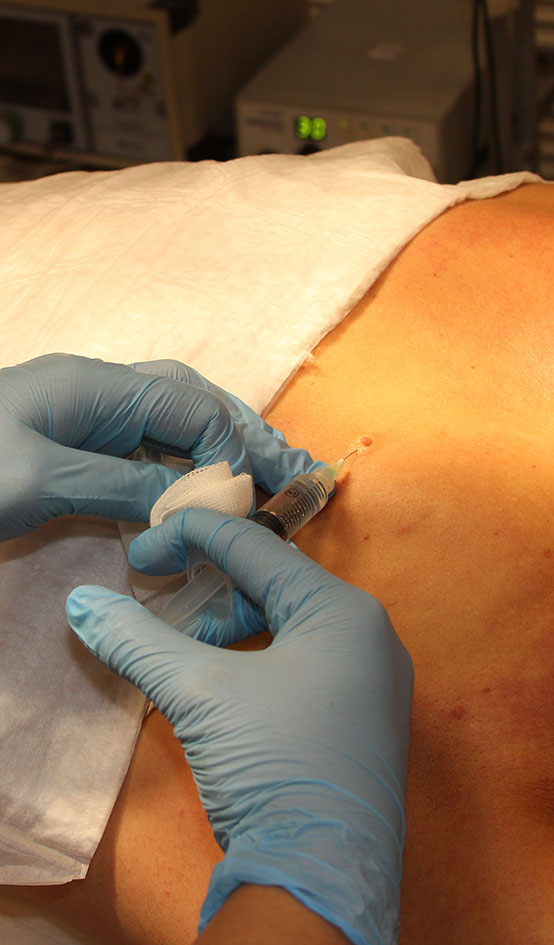 Удаление папиллом лазером Удаление папиллом лазером