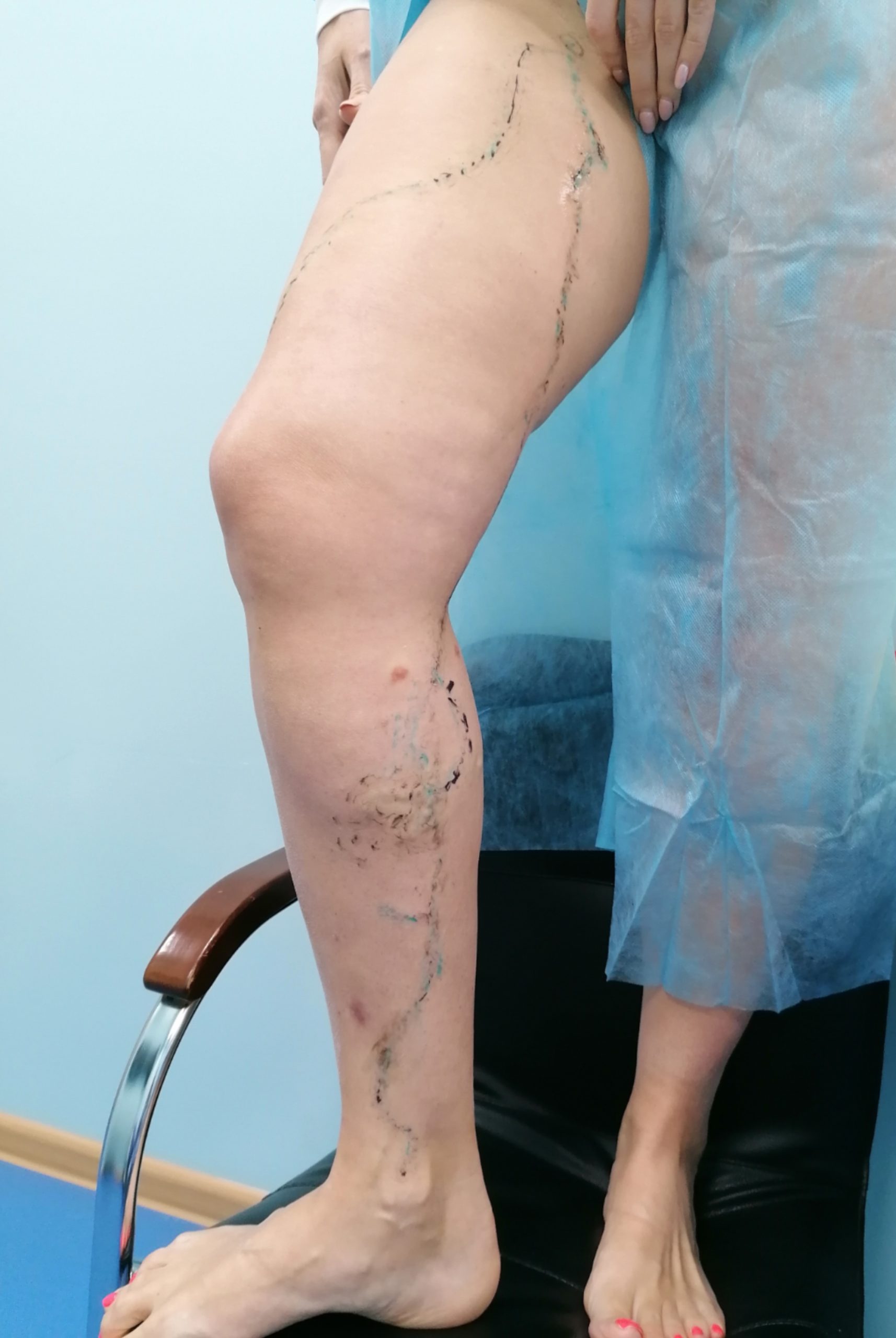 Способы лечения варикоза у женщин