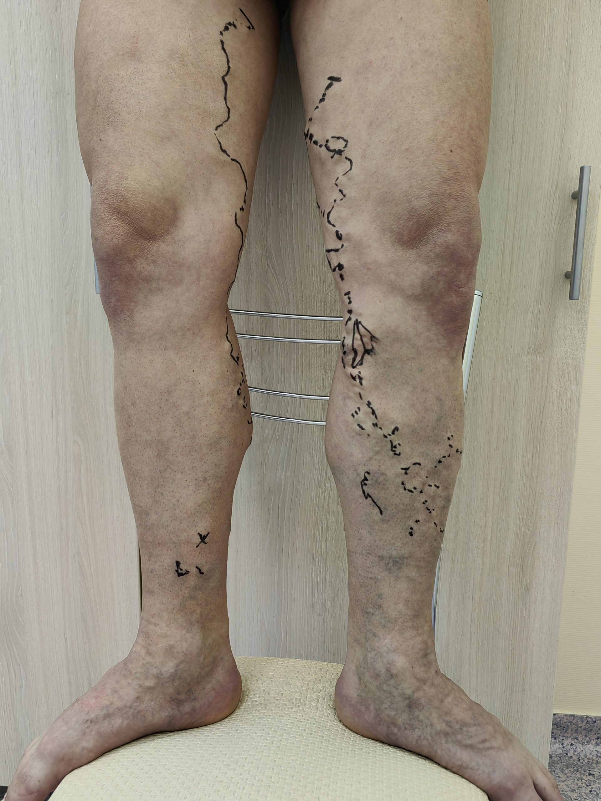 Варикоз ног