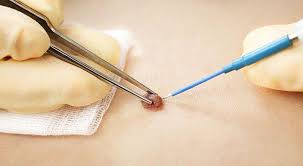 Преимущества лазерного удаления папиллом