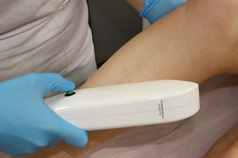 Показания к удалению сосудов на ногах