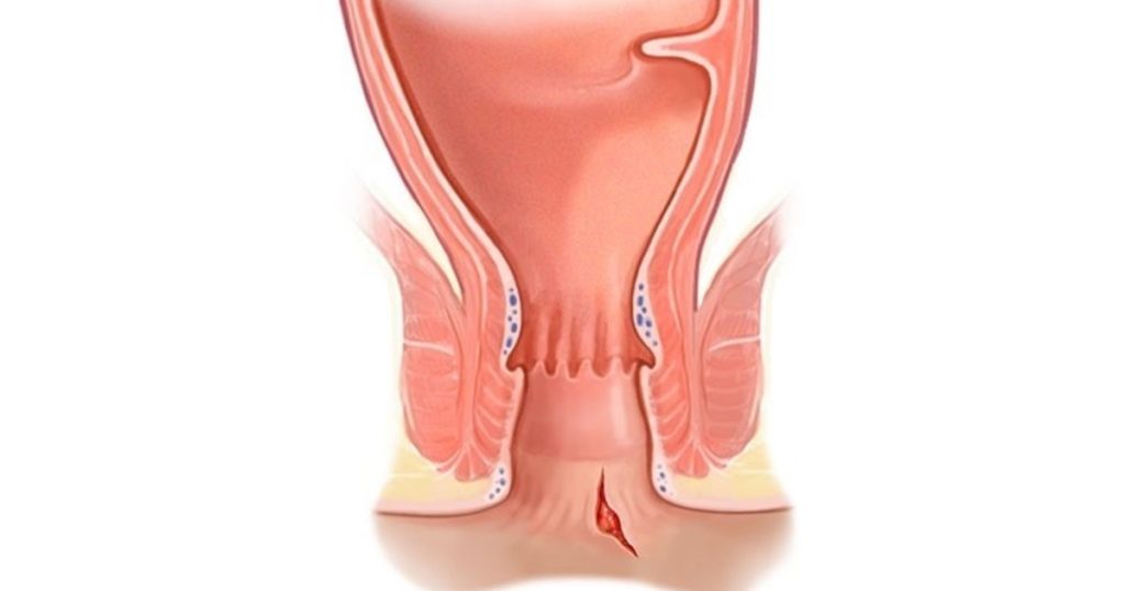 Лечение анальной трещины