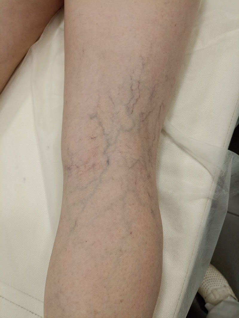 Удаление сосудистых звездочек на ногах в клинике Бегмы