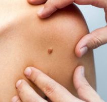 Лечение папиллом