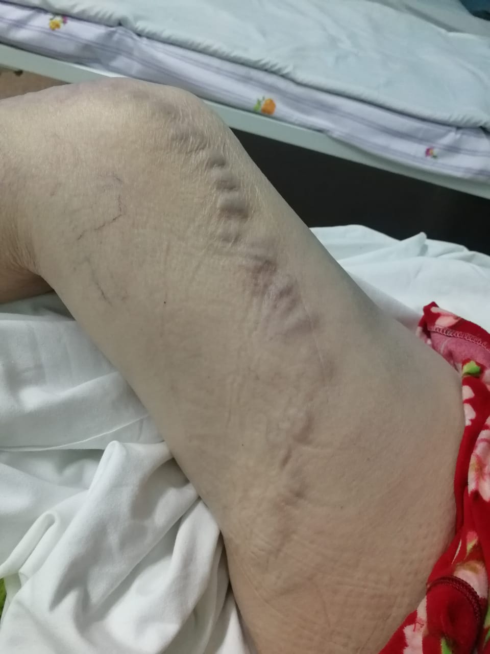 С какими симптомами обращаться на консультацию к флебологу