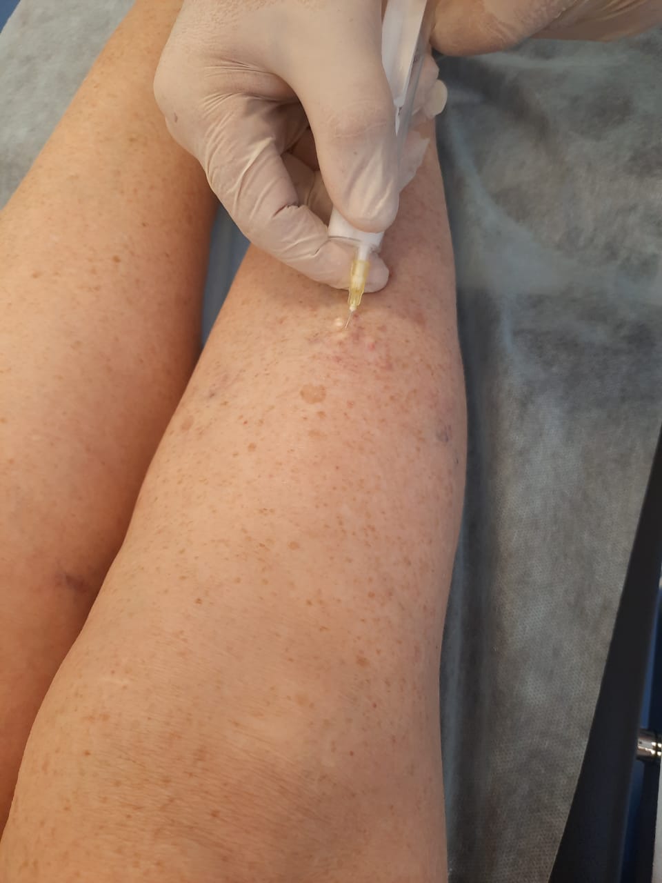 Склеротерапия вен