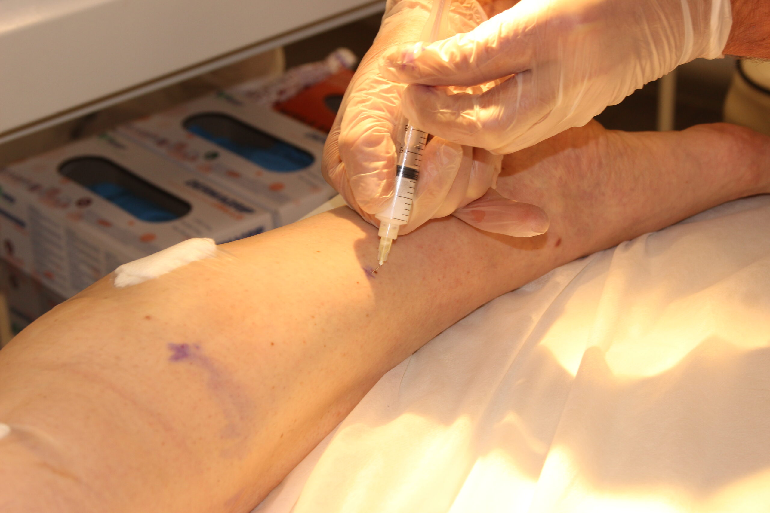 Преимущества микросклеротерапии