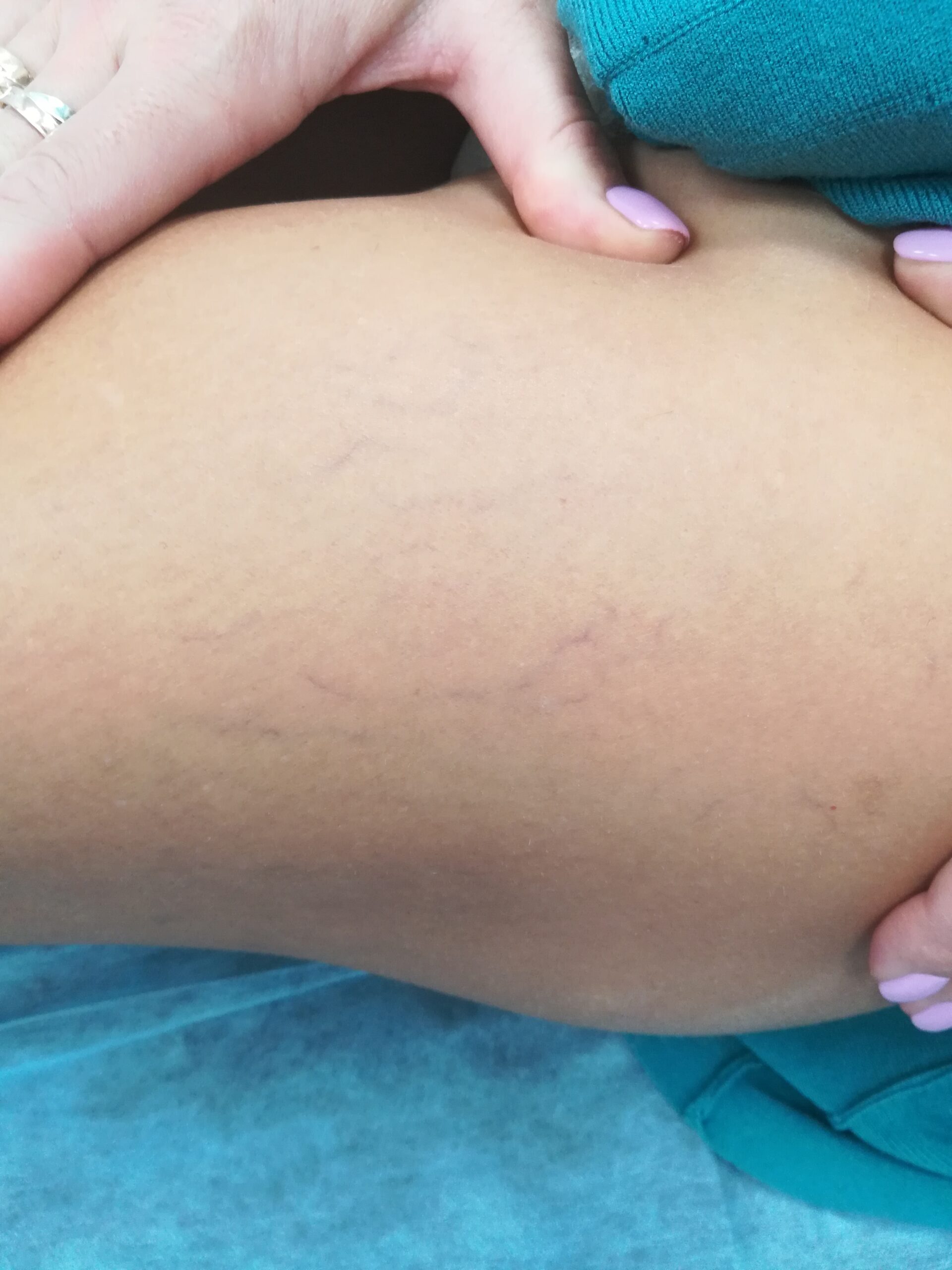 Показания к микросклеротерапии