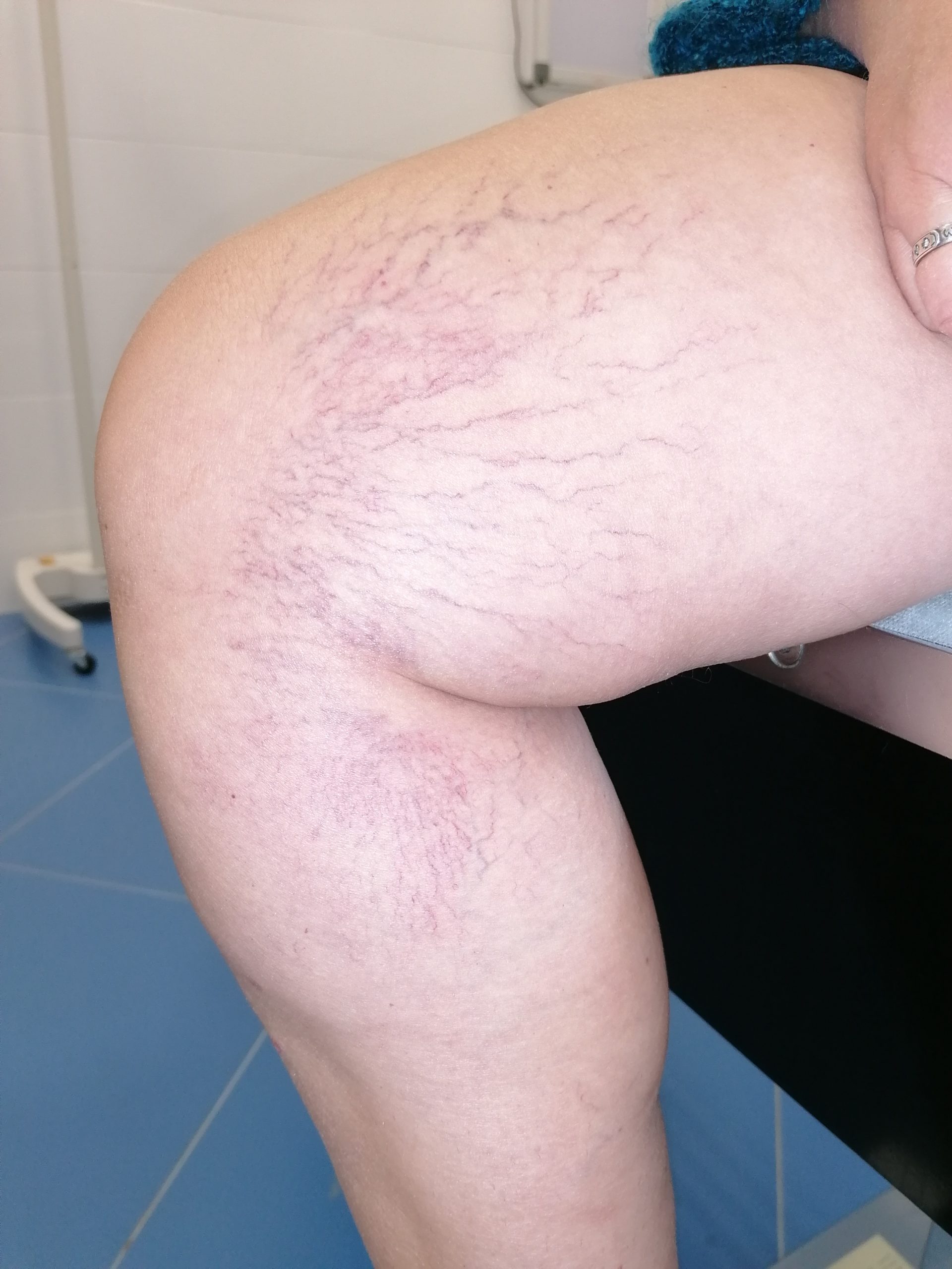 Хирургическое лечение заболевания