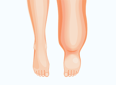 Лечение лимфостаза