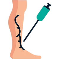 Микросклеротерапия