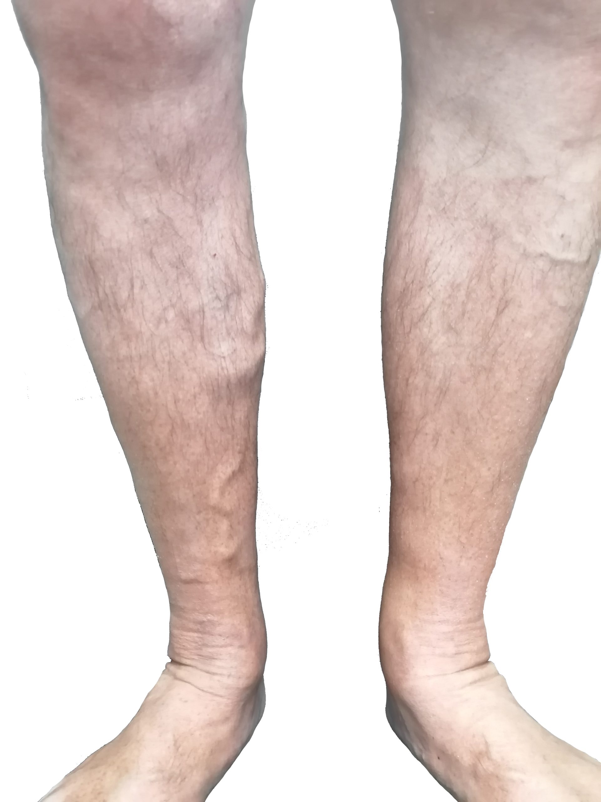 Показания к лазерному лечению варикоза