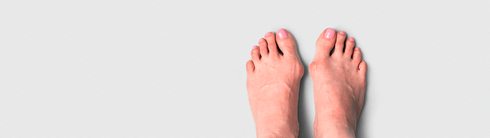 Лечение вальгусной деформации стопы