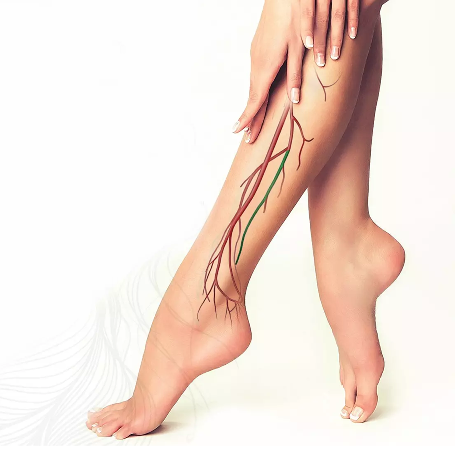 Варикоз ног