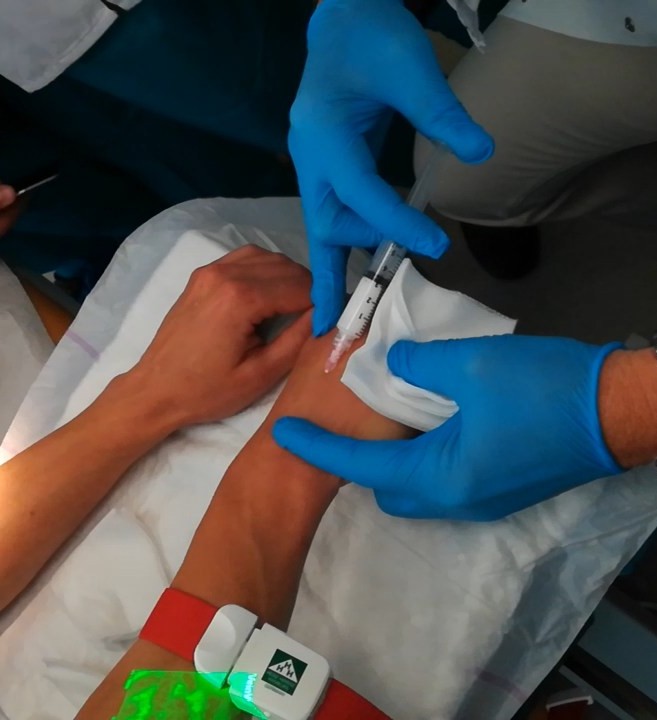 Варикоз рук