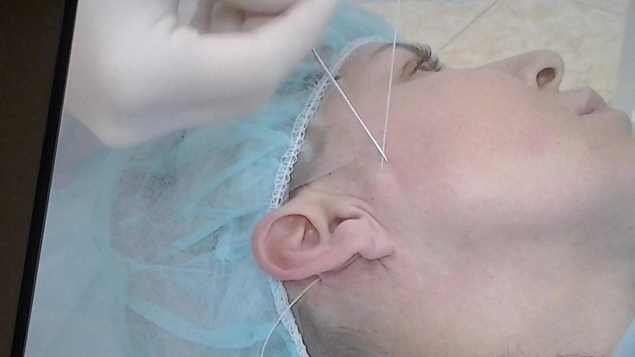 Нитевой лифтинг