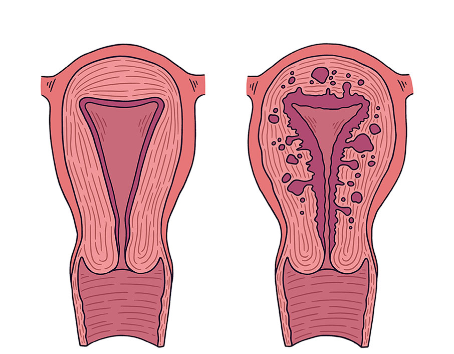 Аденомиоз и эндометриоз Аденомиоз и эндометриоз