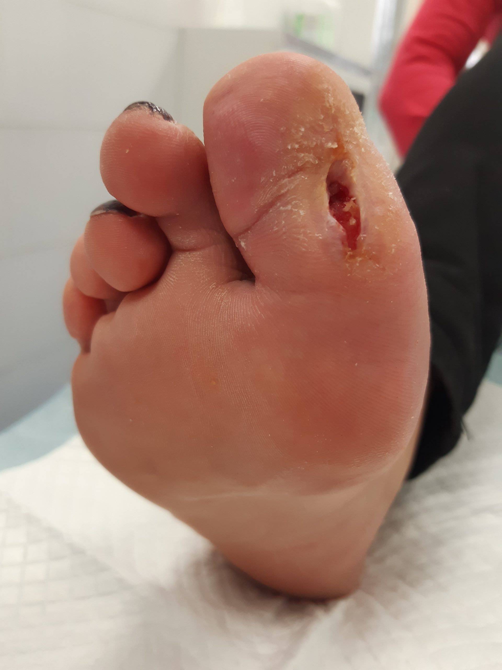 Какие мази и растворы применяют при лечении диабетической стопы