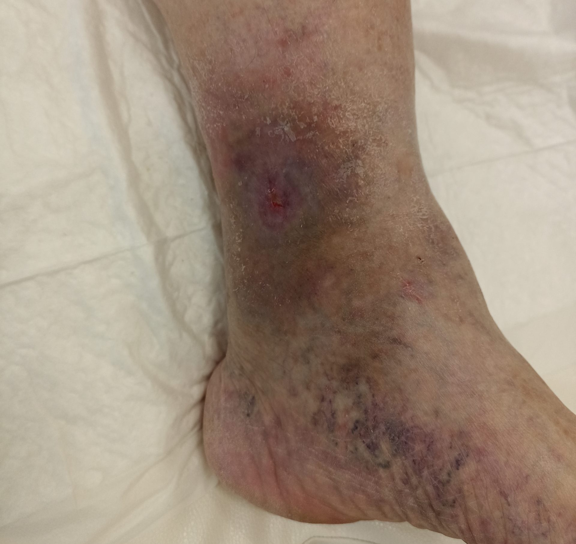 Трофические язвы