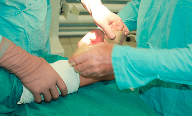 Операция при вальгусной деформации стопы