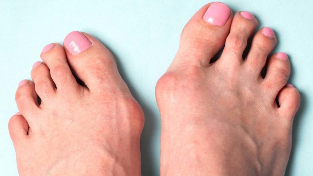 Наружное отклонение (деформация) большого пальца стопы