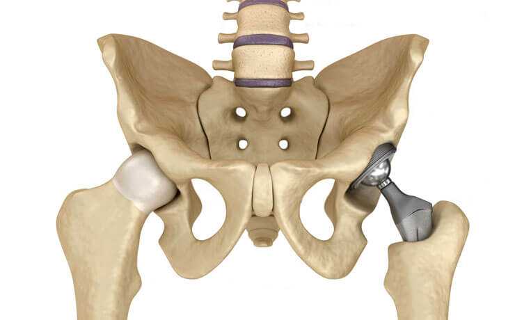 Эндопротезирование тазобедренного сустава — инвалидность?