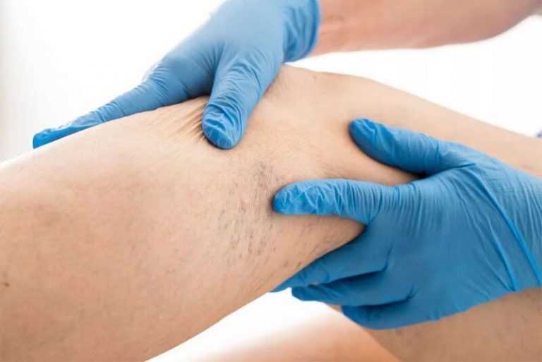 Ретикулярный варикоз