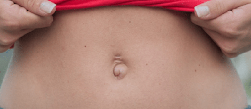 Пупочная грыжа