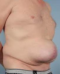 Грыжи живота: современное лечение