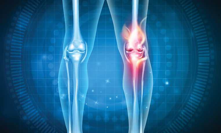 Ревматоидный артрит колена и таза