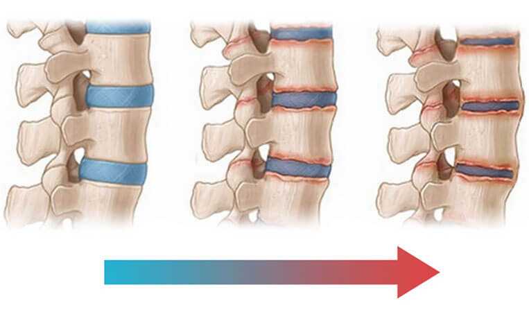 Может ли болезнь Бехтерева привести к протезированию бедра?