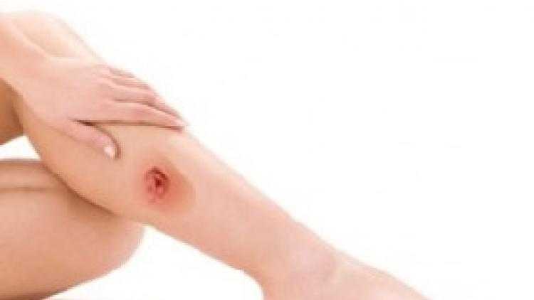 Как и почему появляются трофические язвы