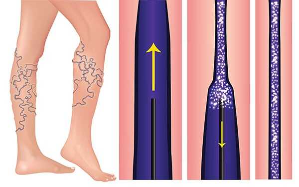 Радиочастотная облитерация