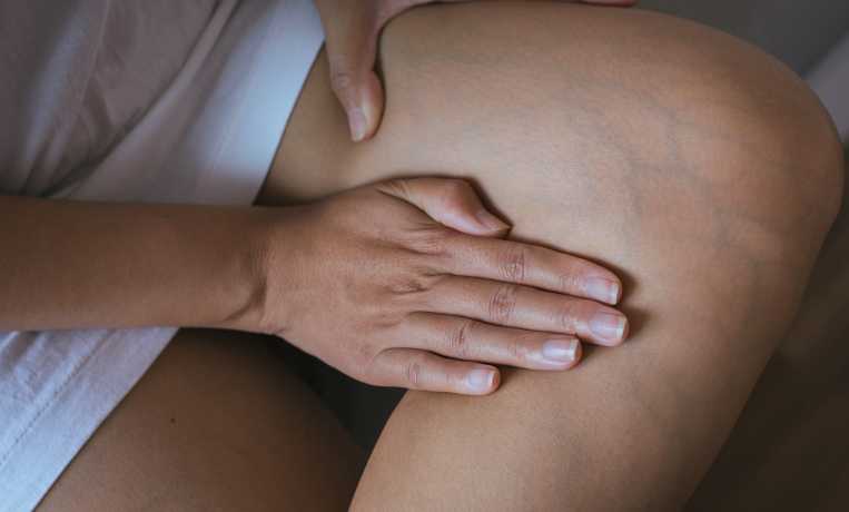 Лекарство от варикоза