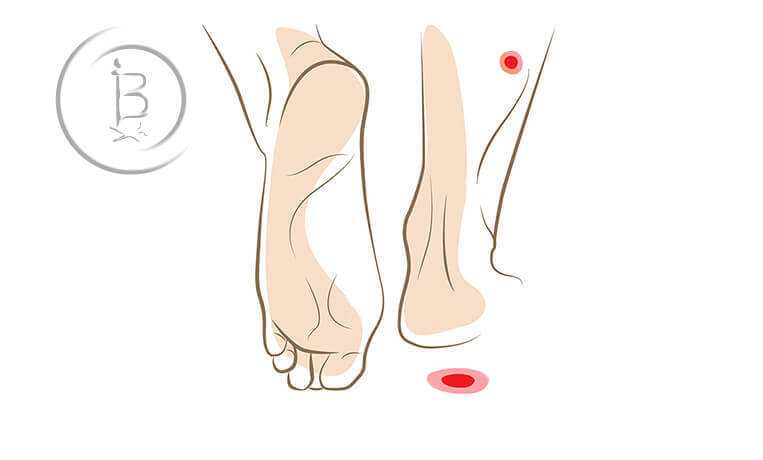 Варикозная трофическая язва