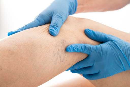 Причины развития варикоза вен нижних конечностей