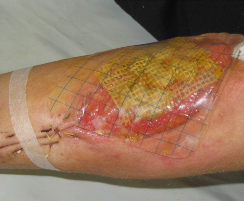 Мы сможем вылечить любую трофическую язву!