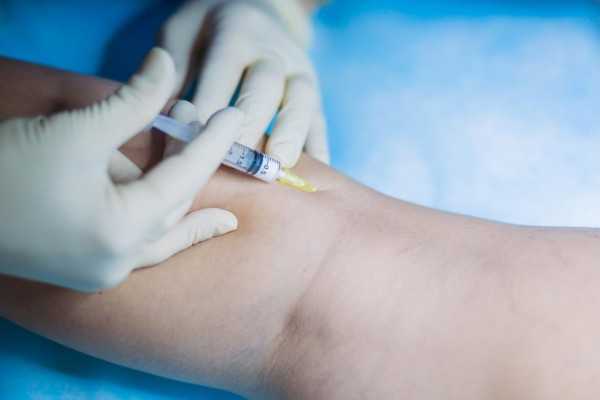 Склеротерапия