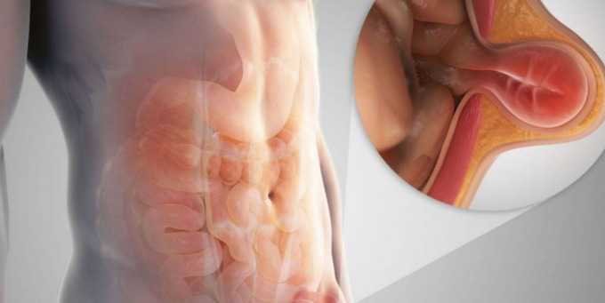 ГРЫЖА ЖИВОТА – ВИДЫ, СИМПТОМЫ, ЛЕЧЕНИЕ