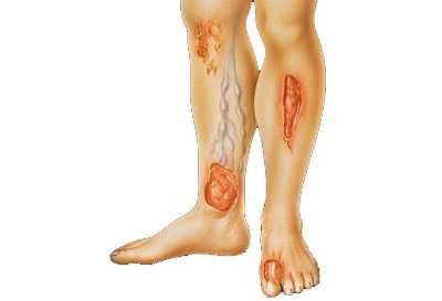 Трофические язвы: причины, симптомы, лечение