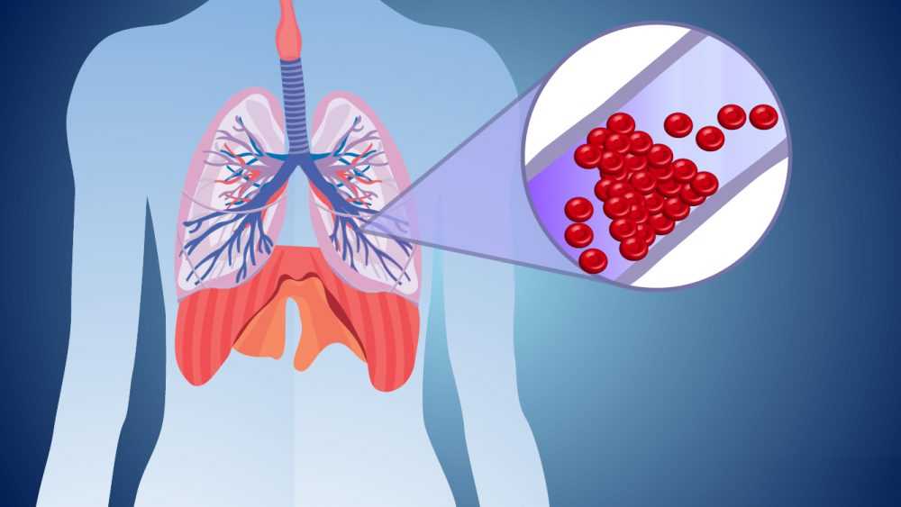 Тромбоэмболия легочной артерии