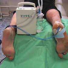 Вакуум-терапия при лечении трофических язв