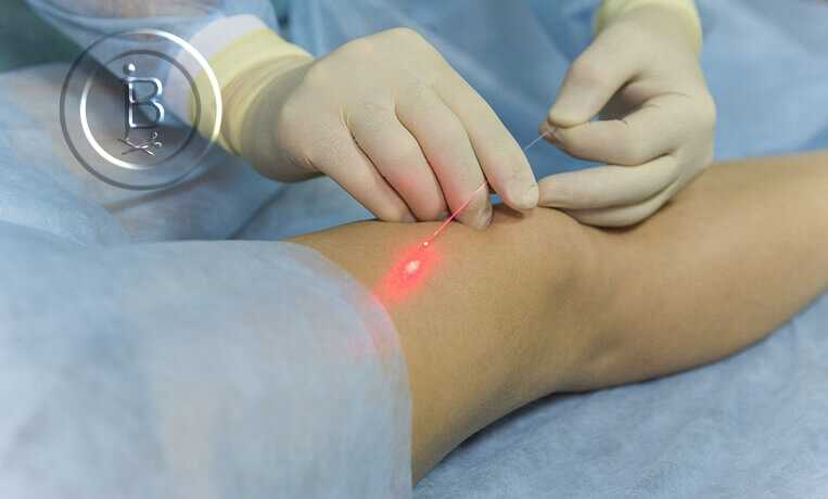 Флебэктомия