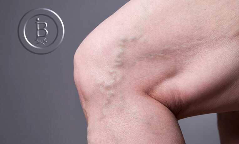 Выступающие вены на ногах. Нужно ли беспокоиться?