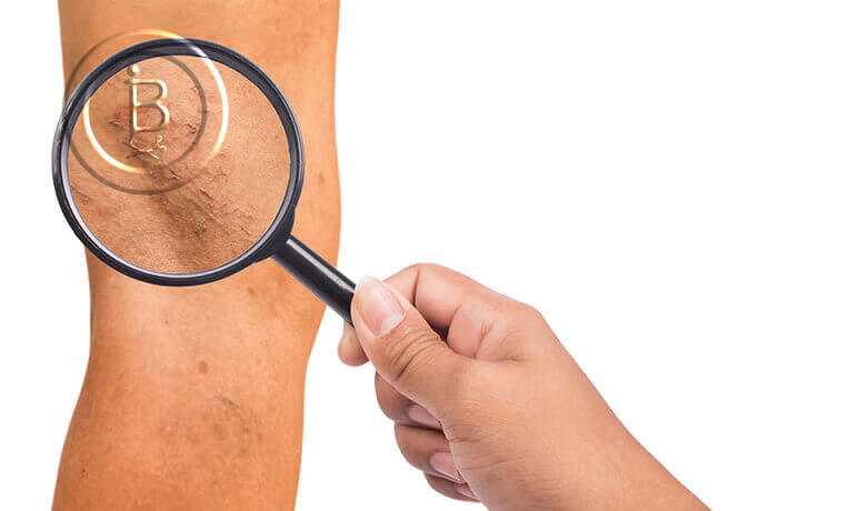 Симптомы, диагностика и лечение варикоза