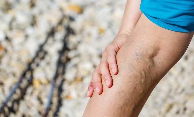 Судороги при варикозе