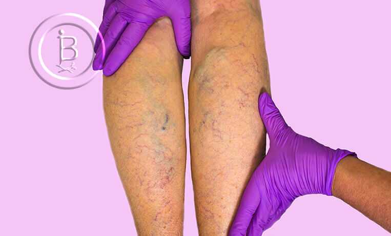 Проблемы с сосудами Симптомы и возможные заболевания вен